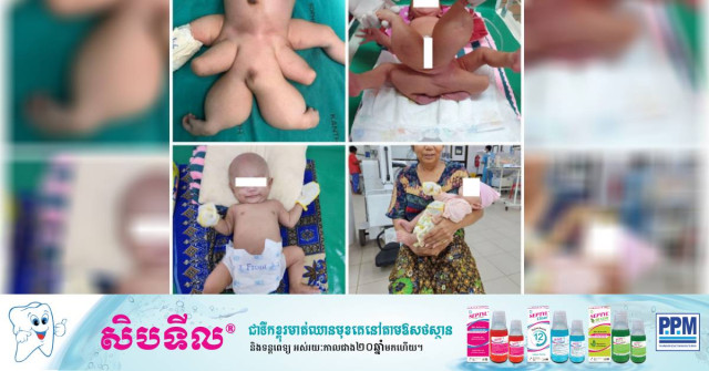 Baby with Parasitic Twin Saved at Kantha Bopha Hospital 